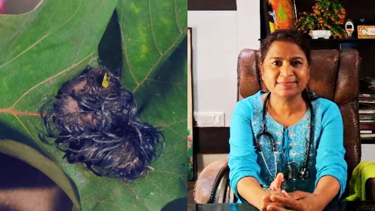 Amravati News : पोटात दुखतं म्हणून डॉक्टरकडे गेली, मुलीच्या पोटातून काढला केसांचा गोळा; कुटुंबीय हादरले