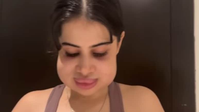 बुरी तरह फूला चेहरा, सूजे गए होंठ, उर्फी जावेद के नए वीडियो ने किया हैरान, पहचानना मुश्किल बुरी तरह फूला चेहरा, सूजे गए होंठ, उर्फी जावेद के नए वीडियो ने किया हैरान, पहचानना मुश्किल