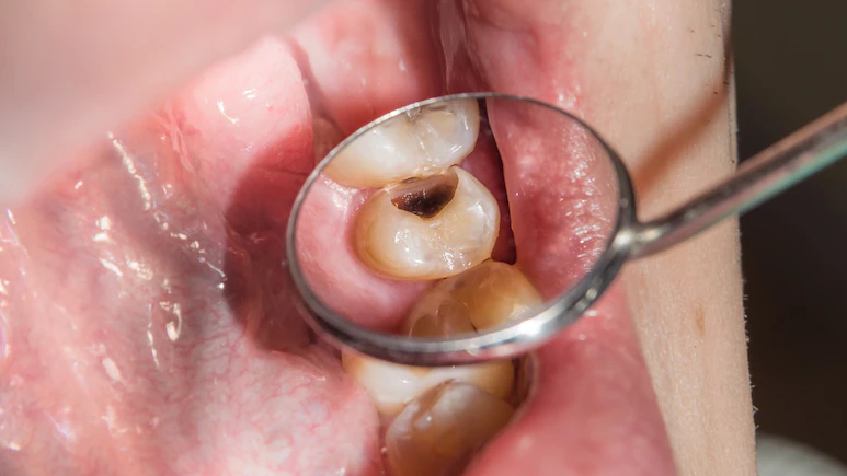 दांतों के कीड़ों को जड़ खत्म कर देगा किचन में मौजूद ये छोटा सा मसाला