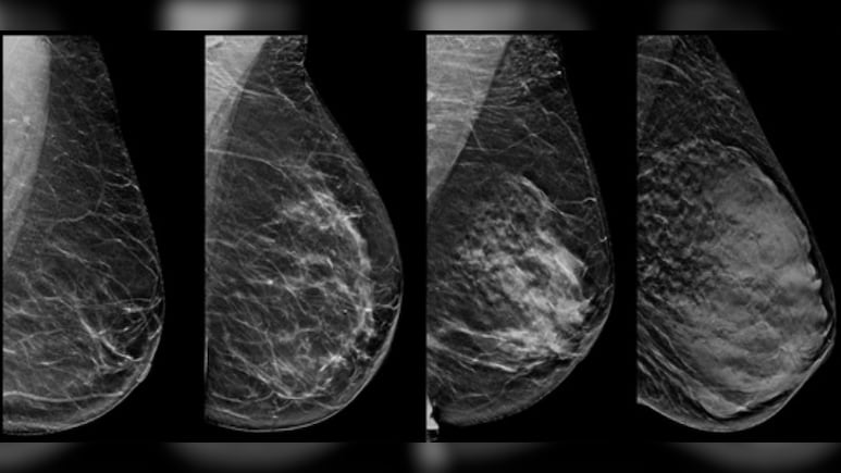 Breast Cancer: निगेटिव मैमोग्राफी रिपोर्ट के बाद भी हो सकता है ब्रेस्ट कैंसर, ब्रेस्ट डेंसिटी है छुपा हुआ खतरा, जाने क्या है Breast Density