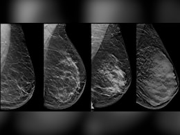 Breast Cancer: निगेटिव मैमोग्राफी रिपोर्ट के बाद भी हो सकता है ब्रेस्ट कैंसर, ब्रेस्ट डेंसिटी है छुपा हुआ खतरा, जाने क्या है Breast Density Breast Cancer: निगेटिव मैमोग्राफी रिपोर्ट के बाद भी हो सकता है ब्रेस्ट कैंसर, ब्रेस्ट डेंसिटी है छुपा हुआ खतरा, जाने क्या है Breast Density