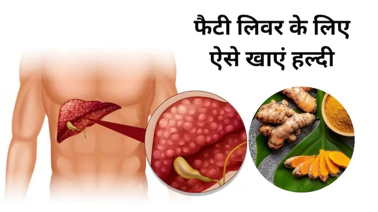 Fatty Liver से बचना है तो ऐसे खाएं हल्दी, आयुर्वेदिक एक्सपर्ट ने बताया जबरदस्त नुस्खा Fatty Liver से बचना है तो ऐसे खाएं हल्दी, आयुर्वेदिक एक्सपर्ट ने बताया जबरदस्त नुस्खा