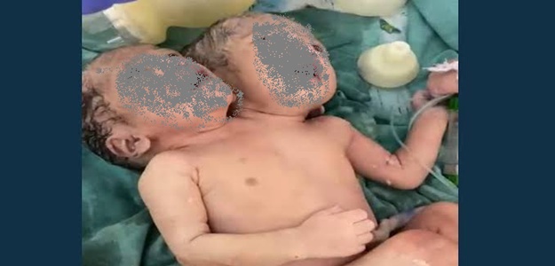 Two Headed Baby: इंदौर में दो सिर वाली बच्ची का जन्म; दो लाख में एक दुर्लभ मामला, एक शरीर में दो दिल