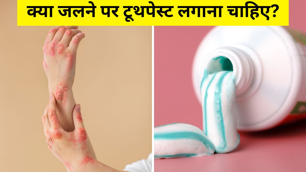 क्या जलने पर टूथपेस्ट लगाना चाहिए? डॉक्टर ने बताया अगर जल जाए, तो सबसे पहले घर पर क्या करें