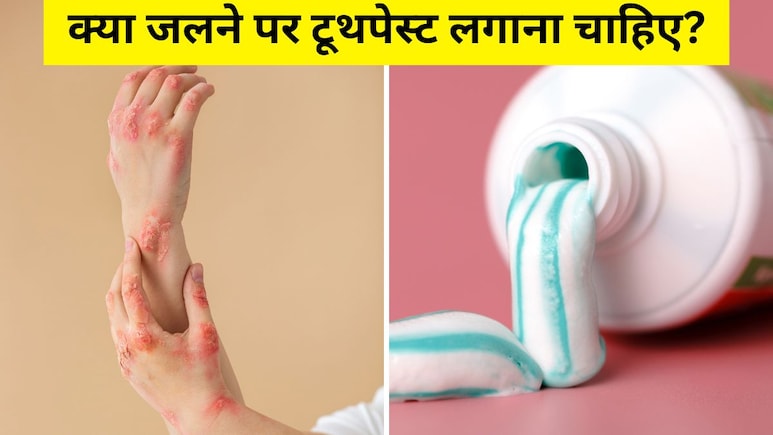 क्या जलने पर टूथपेस्ट लगाना चाहिए? डॉक्टर ने बताया अगर जल जाए, तो सबसे पहले घर पर क्या करें क्या जलने पर टूथपेस्ट लगाना चाहिए? डॉक्टर ने बताया अगर जल जाए, तो सबसे पहले घर पर क्या करें