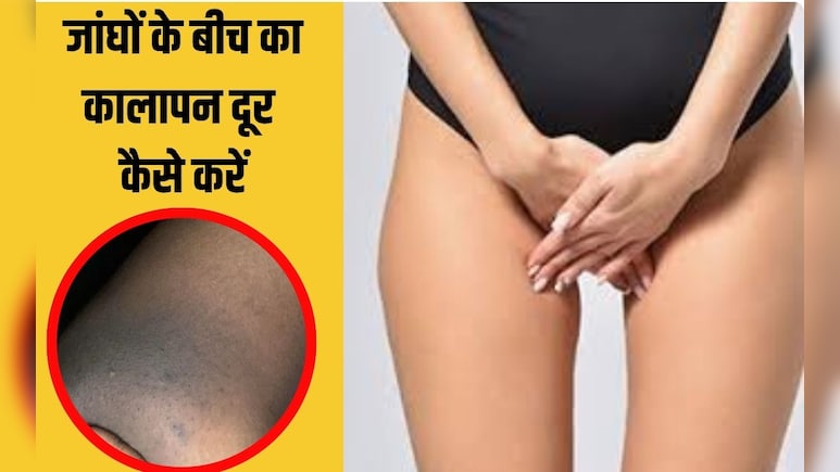 जांघों के कालापन के ये हैं लक्षण, डॉक्‍टर ने बताया इस तरह से दूर कर सकते हैं थाइज की डार्कनेस