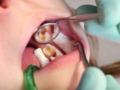 Cavity Remedies: दांतों के कीड़ों को जड़ से खत्म कर देंगी किचन में मौजूद ये सस्ती सी चीजें