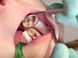 Cavity Remedies: दांतों के कीड़ों को जड़ से खत्म कर देंगी किचन में मौजूद ये सस्ती सी चीजें