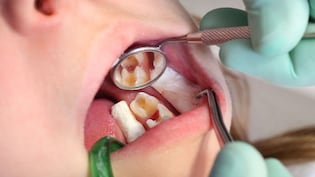 Cavity Remedies: दांतों के कीड़ों को जड़ से खत्म कर देंगी किचन में मौजूद ये सस्ती सी चीजें