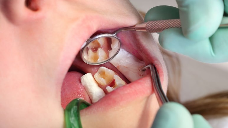 Cavity Remedies: दांतों के कीड़ों को जड़ से खत्म कर देंगी किचन में मौजूद ये सस्ती सी चीजें