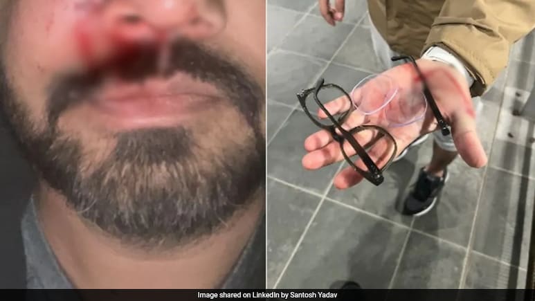 आयरलैंड में एक और भारतीय मूल के व्यक्ति पर "नस्लवादी" हमला, गाल की हड्डी तक तोड़ी