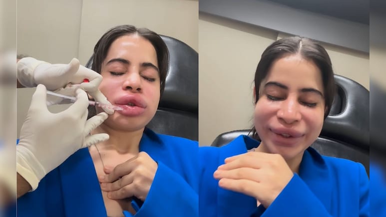 Urfi Javed: सुजलेले ओठ, लालबुंद तोंड.. उर्फी जावेदच्या चेहऱ्याची झाली दुर्दशा, पाहा VIDEO