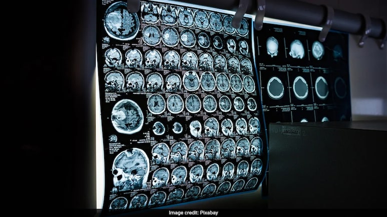Neurocysticercosis: Experts Weigh In On This "Serious" Brain Infection That Increases During Monsoon Neurocysticercosis: Experts Weigh In On This "Serious" Brain Infection That Increases During Monsoon