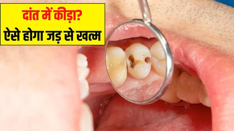 दांत में लग गया है कीड़ा? डेंटिस्ट ने बताया दांत को खोखला होने से रोकने का सबसे आसान तरीका, एक काम करने से मोती जैसे सफेद रहेंगे Teeth