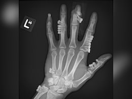 क्या वाकई ज़्यादा कैल्शियम हो जाए तो हड्डियों में उग जाते हैं दांत, जानें क्या है Hypercalcemia, इसके लक्षण