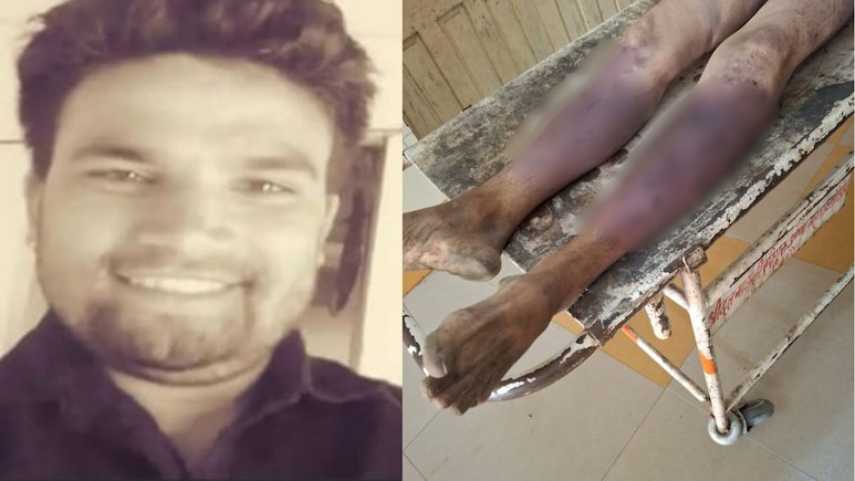 40 Fractures, Blunt Trauma: Indore Man Dies After Mob Assault Over Theft 40 Fractures, Blunt Trauma: Indore Man Dies After Mob Assault Over Theft