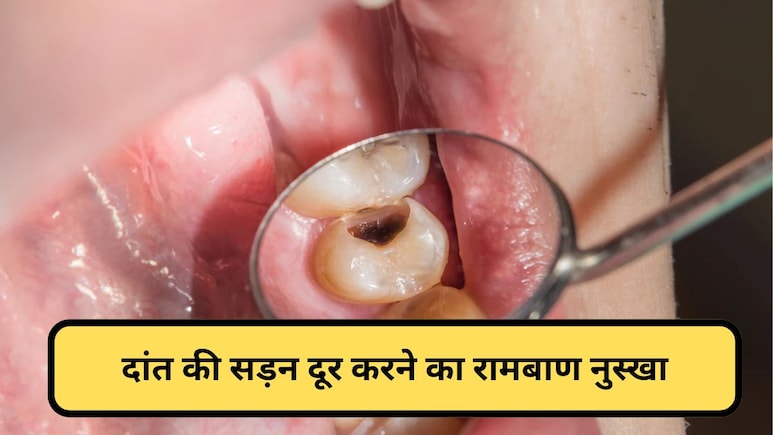 क्या दांत की कैविटी को प्राकृतिक रूप से ठीक किया जा सकता है? एक्सपर्ट ने बताया नुस्खा