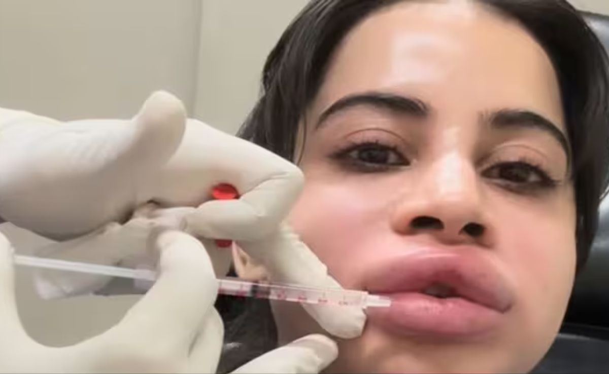 Uorfi Javed ने हटवाए अपने लिप फिलर्स, जानिए Lip Fillers के फायदे और नुकसान क्या होते हैं और कीमत कितनी होती है