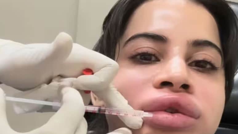 Uorfi Javed ने हटवाए अपने लिप फिलर्स, जानिए Lip Fillers के फायदे और नुकसान क्या होते हैं और कीमत कितनी होती है
