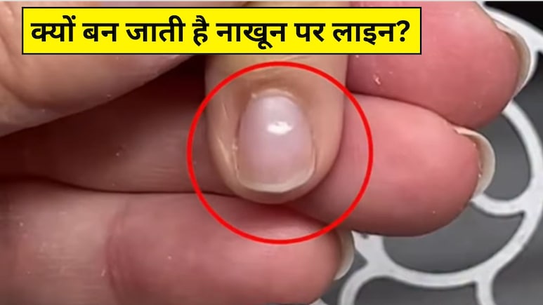 नाखून पर सफेद लाइन आने का क्या मतलब है? डॉक्टर ने बताया कैल्शियम की कमी नहीं ये होती है बड़ी वजह