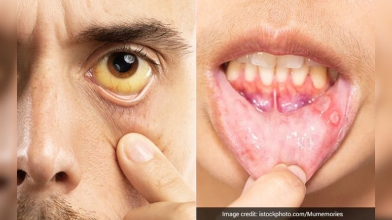 Vitamin B12 की कमी के हैं ये 5 सबसे बड़े लक्षण, डॉक्टर ने बताया क्या करने से कभी कम नहीं होगा विटामिन बी12