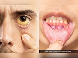 Vitamin B12 की कमी के हैं ये 5 सबसे बड़े लक्षण, डॉक्टर ने बताया क्या करने से कभी कम नहीं होगा विटामिन बी12 Vitamin B12 की कमी के हैं ये 5 सबसे बड़े लक्षण, डॉक्टर ने बताया क्या करने से कभी कम नहीं होगा विटामिन बी12
