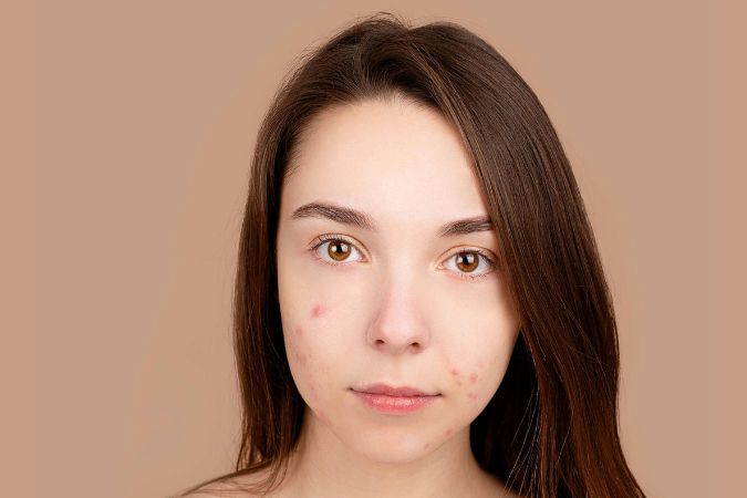 Can Popping A Pimple In 'The Triangle Of Death' On Your Face Actually Kill You?