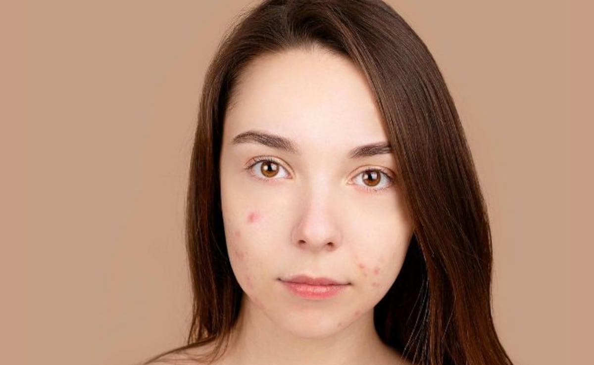 Can Popping A Pimple In 'The Triangle Of Death' On Your Face Kill You?