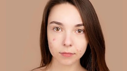 Can Popping A Pimple In 'The Triangle Of Death' On Your Face Actually Kill You?