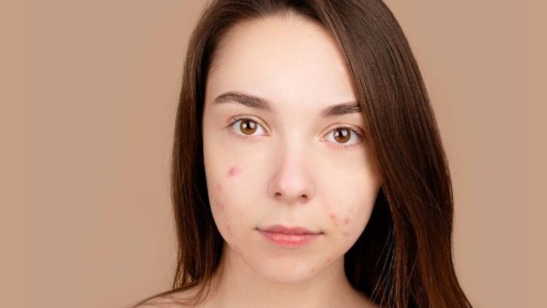 Can Popping A Pimple In 'The Triangle Of Death' On Your Face Actually Kill You?