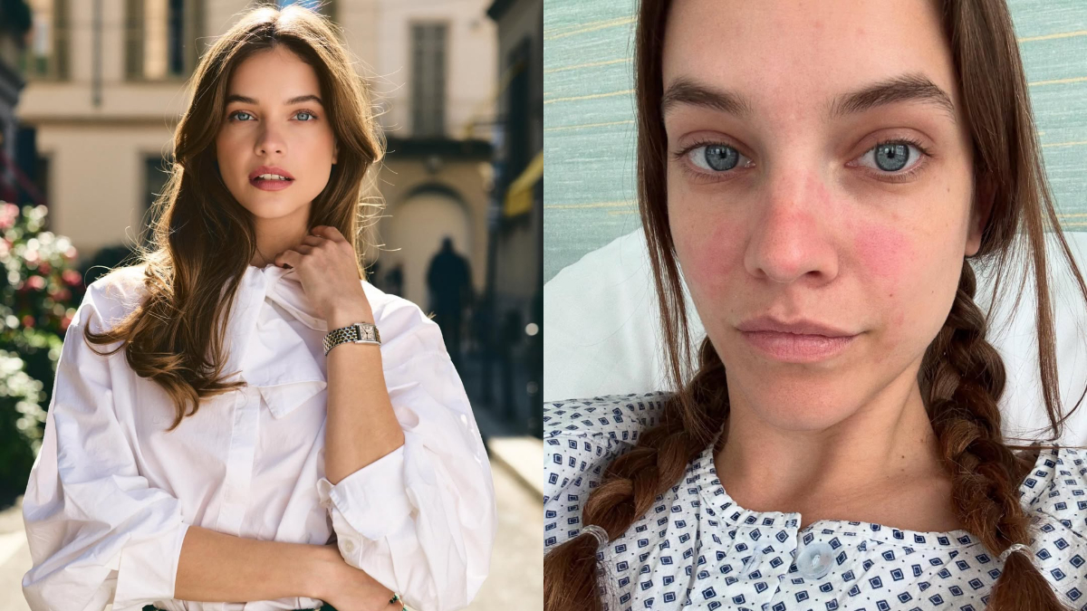 Model And Actor Barbara Palvin Opens Up About Endometriosis Diagnosis: Know What It Means