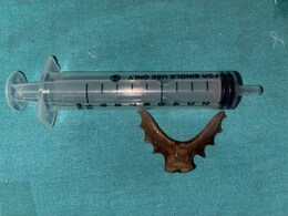 मरीज के भोजन नली में फंसे 7 सेमी के दांत, J.L.N हॉस्पिटल में डॉक्टरों ने कड़ी मशक्कत से बचाई जान