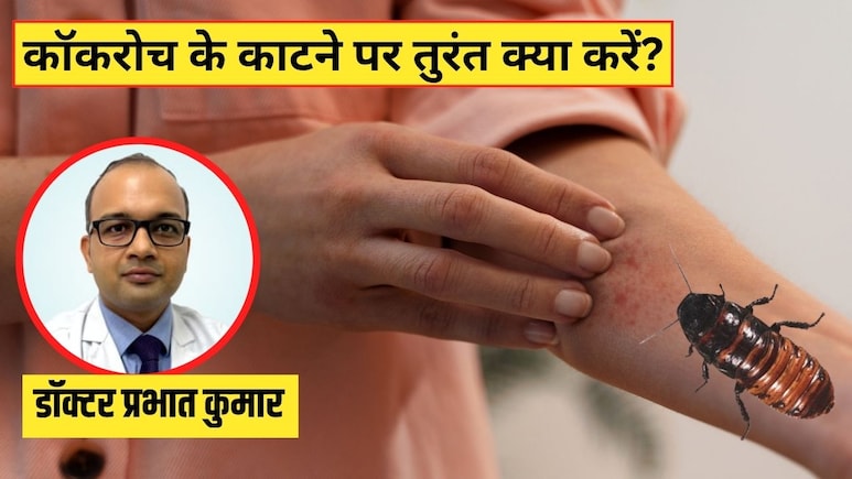 कॉकरोच काट ले तो क्या होता है? डॉक्टर ने बताया इन लक्षणों को न करें नजरअंदाज, जानें सबसे पहले क्या करें