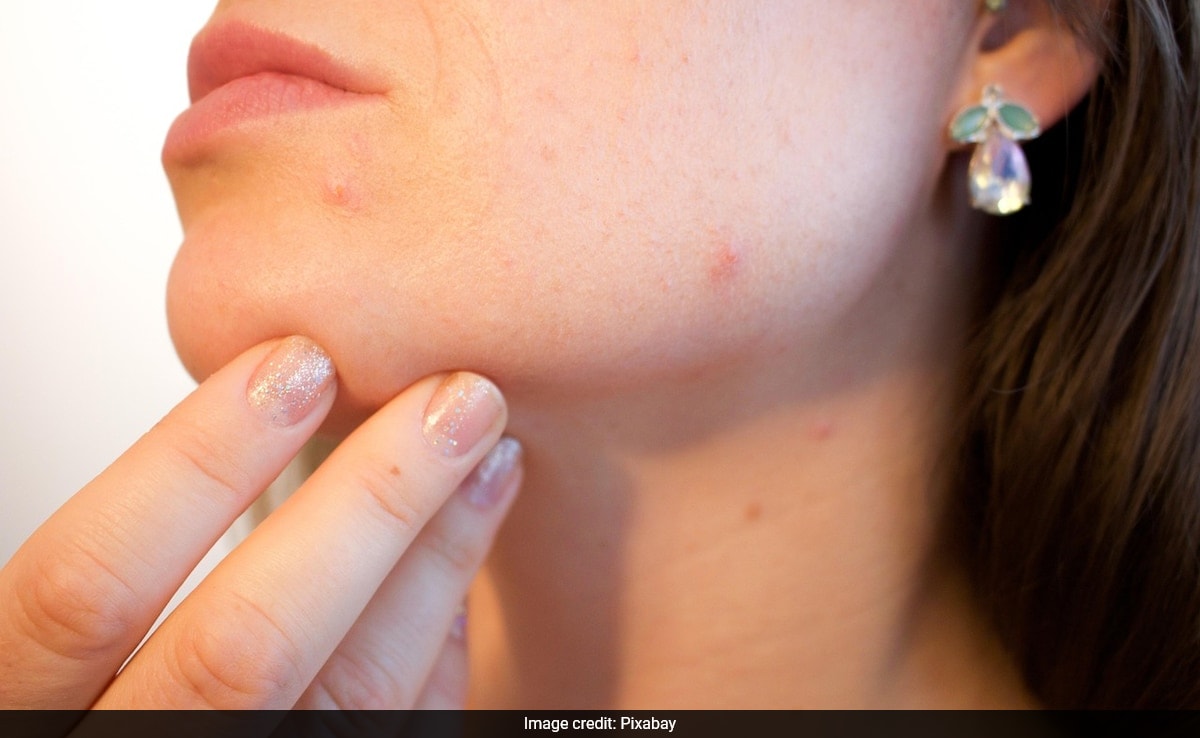 Woman Lands In Hospital After Popping Pimple, Warns of "Triangle Of