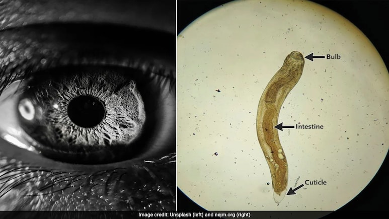 Worm In Eye Leaves Indian Man With Blurred Vision, US Study Finds Worm In Eye Leaves Indian Man With Blurred Vision, US Study Finds