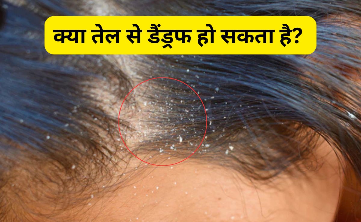 क्या तेल से डैंड्रफ हो सकता है? आयुर्वेदिक एक्सपर्ट ने बताया कैसे बालों पर कौनसा ऑयल लगाना चाहिए
