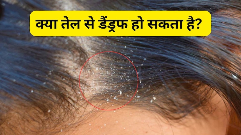 क्या तेल से डैंड्रफ हो सकता है? आयुर्वेदिक एक्सपर्ट ने बताया कैसे बालों पर कौनसा ऑयल लगाना चाहिए क्या तेल से डैंड्रफ हो सकता है? आयुर्वेदिक एक्सपर्ट ने बताया कैसे बालों पर कौनसा ऑयल लगाना चाहिए