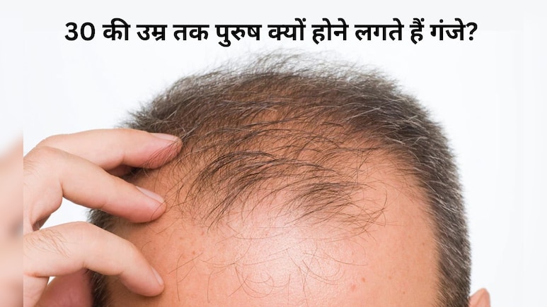 30 की उम्र से पहले ही क्यों झड़ने लगते हैं पुरुषों के बाल? डॉक्टर ने बताया कौन सी गलतियां बनती हैं वजह