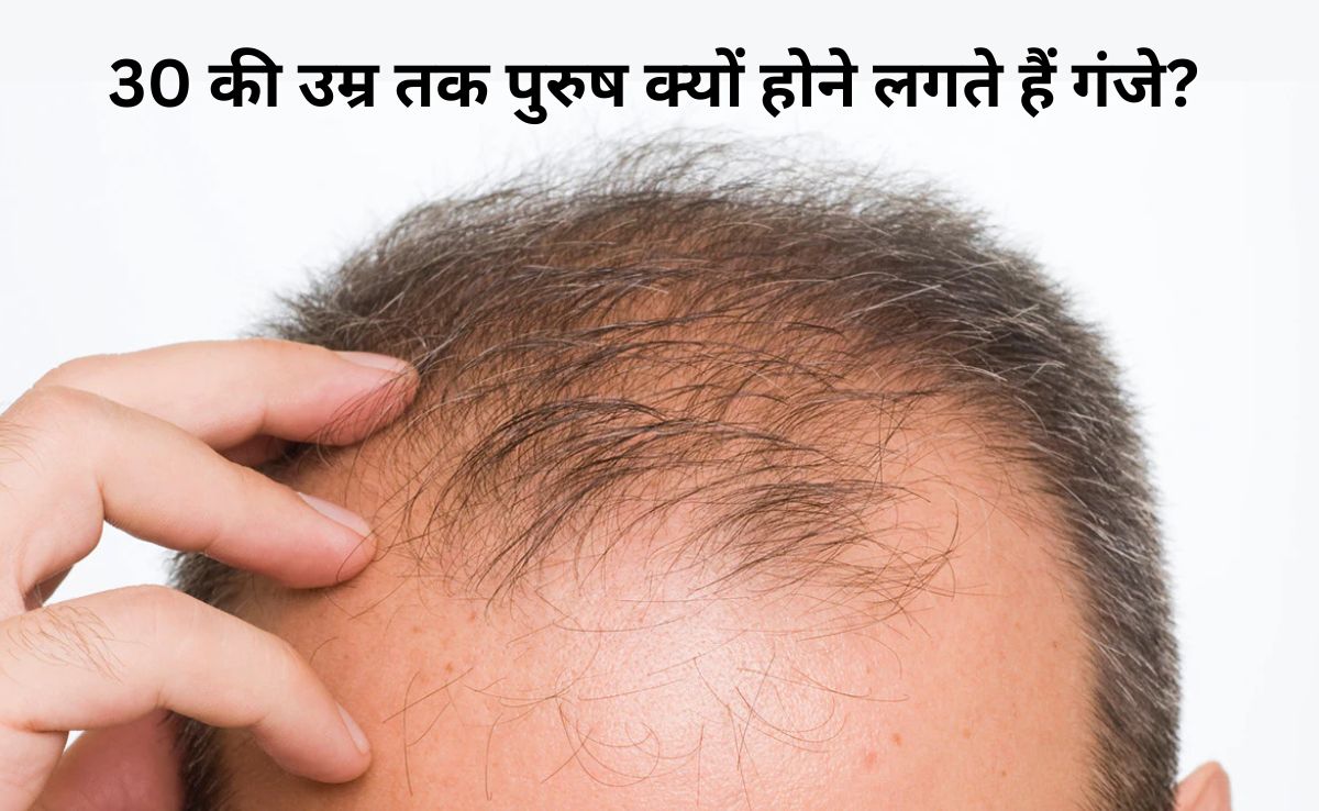 Best foods for hair thickness, Protein rich foods for hair fall,Home remedies for baldness diet,Gane Sir Par Naye Baal Kaise Ugaye,Foods for new hair growth,Diet to regrow hair naturally ,Best foods for hair thickness, Protein rich foods for hair fall,, Home remedies for baldness diet Latest and Breaking News on NDTV