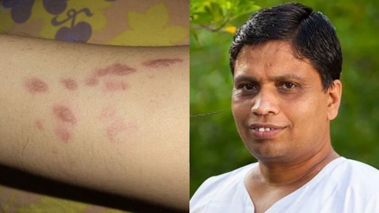 Acharya Balkrishna ने बताया पुराने जले के निशान कैसे मिटाएं
