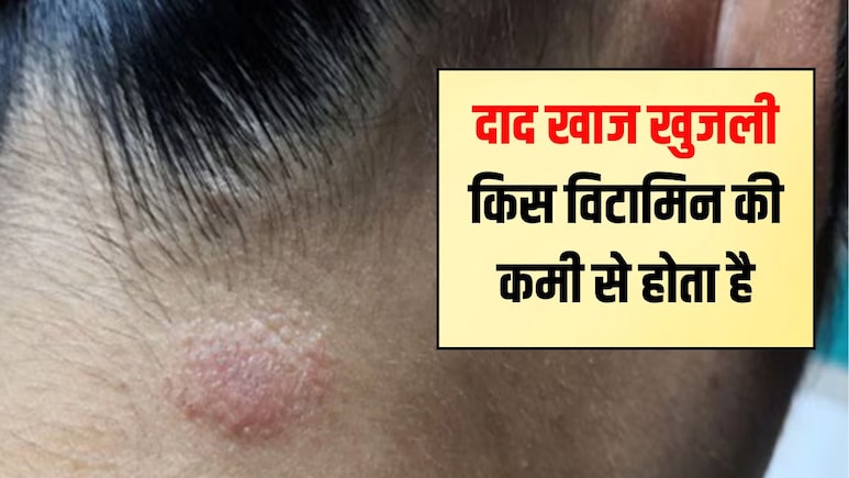 किस विटामिन की कमी से दाद होता है? दाद खाज खुजली को जड़ से खत्म कैसे करें
