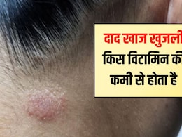 किस विटामिन की कमी से दाद होता है? दाद खाज खुजली को जड़ से खत्म कैसे करें किस विटामिन की कमी से दाद होता है? दाद खाज खुजली को जड़ से खत्म कैसे करें