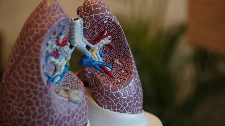 Lung Cancer No More Smokers' Disease: Experts Reveal How Everyone Is Affected, Even Children Lung Cancer No More Smokers' Disease: Experts Reveal How Everyone Is Affected, Even Children