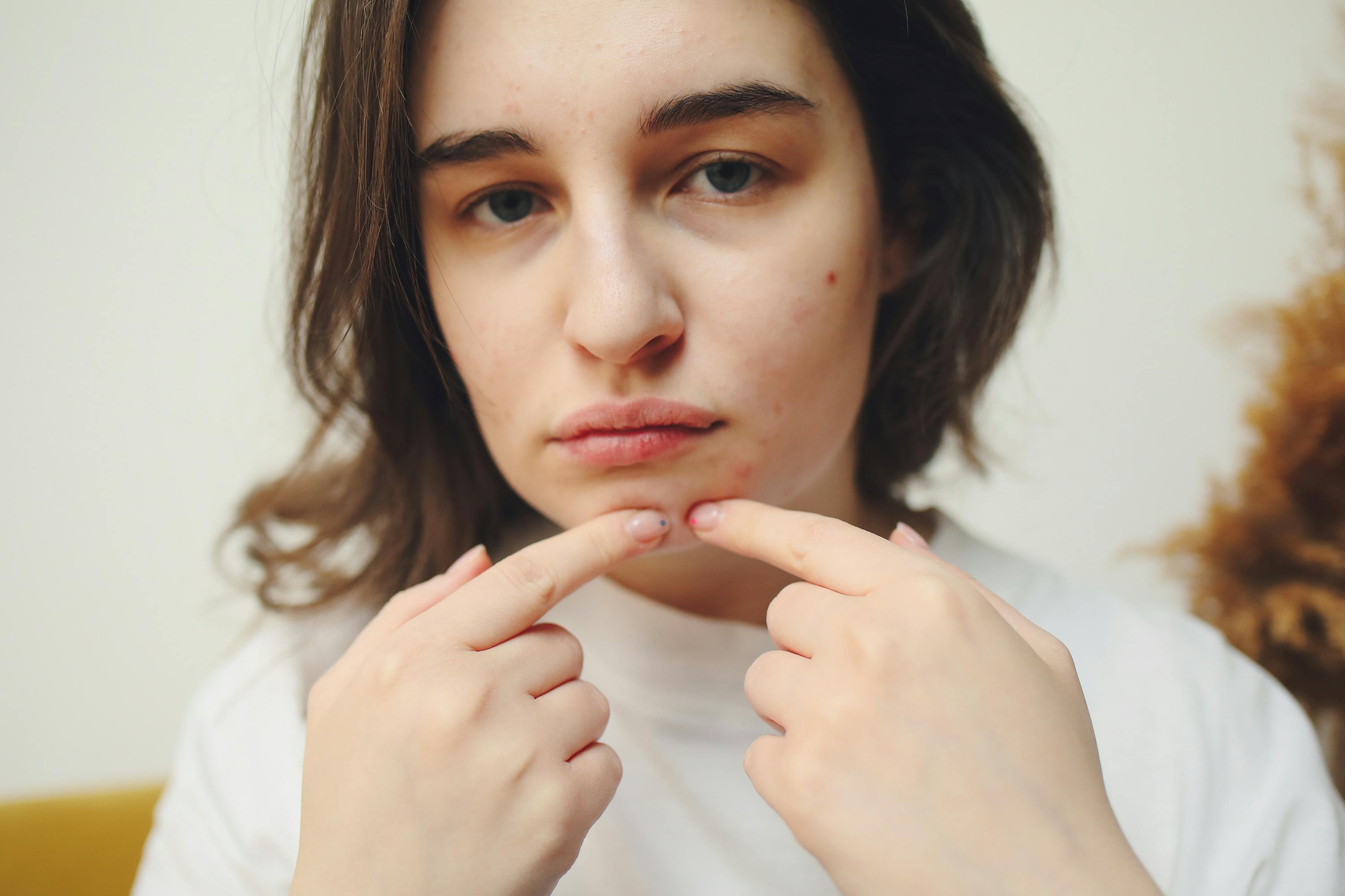 Experts suggest to avoid popping pimples. Photo: Pexels Experts suggest to avoid popping pimples. Photo: Pexels