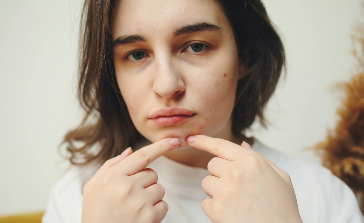 Shahnaz Hussain ने बताया सर्दियों में क्यों निकलते हैं पिंपल और बचने के 5 आसान नुस्खे