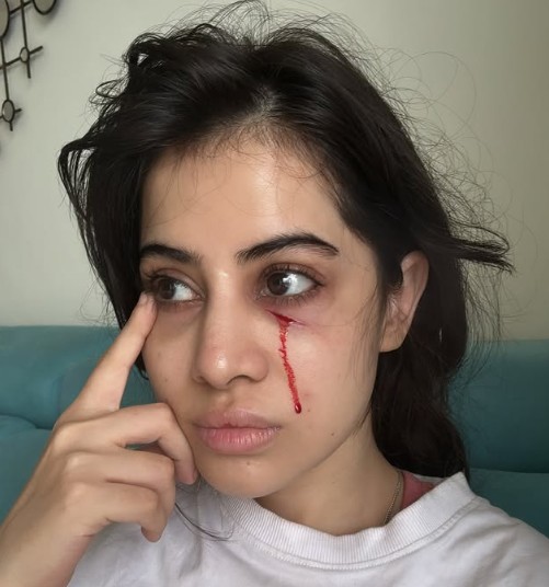 चेहरे की सूजन के बाद अब उर्फी जावेद के चेहरे से बहता दिखा खून, बताई वजह