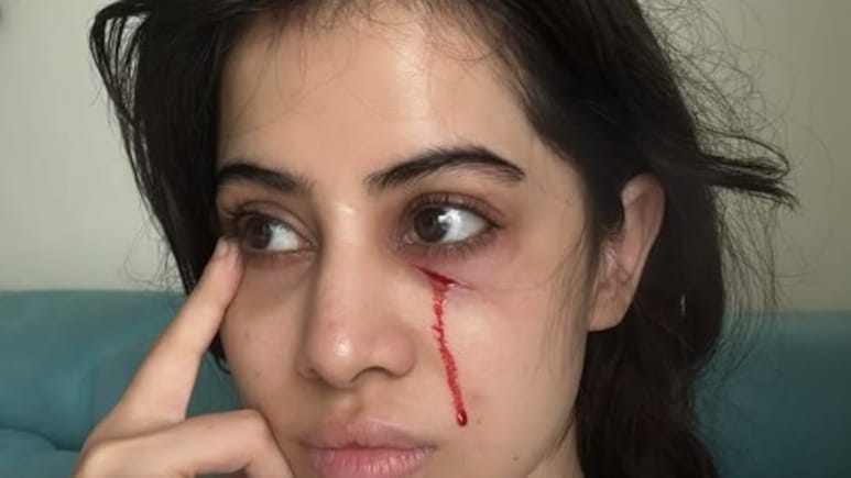चेहरे की सूजन के बाद अब उर्फी जावेद के चेहरे से बहता दिखा खून, बताई वजह