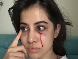 चेहरे की सूजन के बाद अब उर्फी जावेद के चेहरे से बहता दिखा खून, बताई वजह चेहरे की सूजन के बाद अब उर्फी जावेद के चेहरे से बहता दिखा खून, बताई वजह