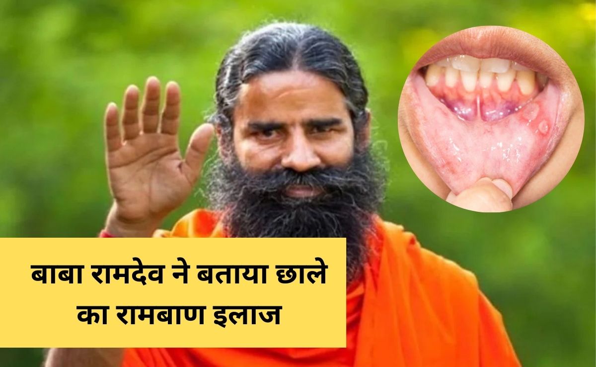किस विटामिन की कमी से छाले हो जाते हैं? बाबा रामदेव से जान लें मुंह के छालों के लिए सबसे अच्छी दवा कौन सी है