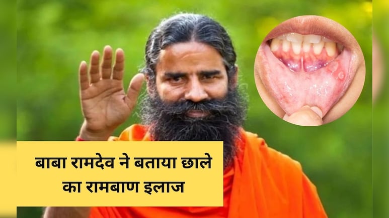 मुंह के छाले की सबसे अच्छी दवा कौन सी है? Baba Ramdev ने कहा इस नुस्खे से कुछ घंटों में ही छाला हो जाएगा ठीक